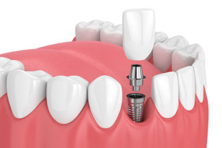 Can you eat normally with dental implants, Grand Rapids MI