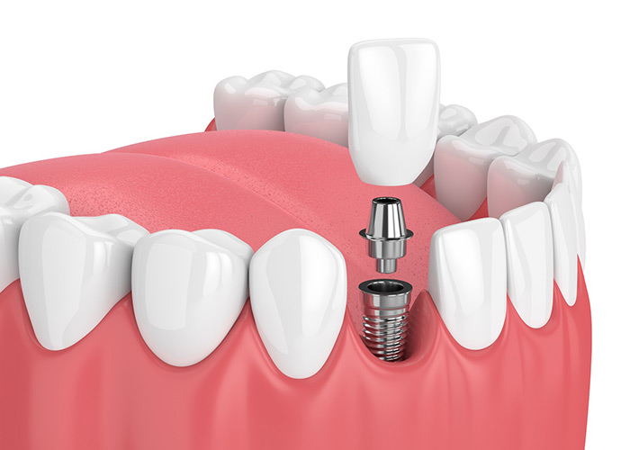 Can you eat normally with dental implants, Grand Rapids MI